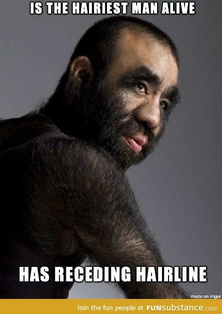 Bad luck 'hairiest man alive'