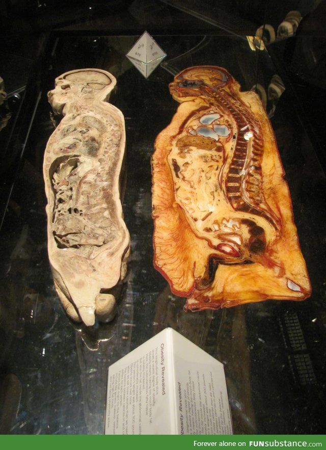 Fat person Vs Skinny person cross section