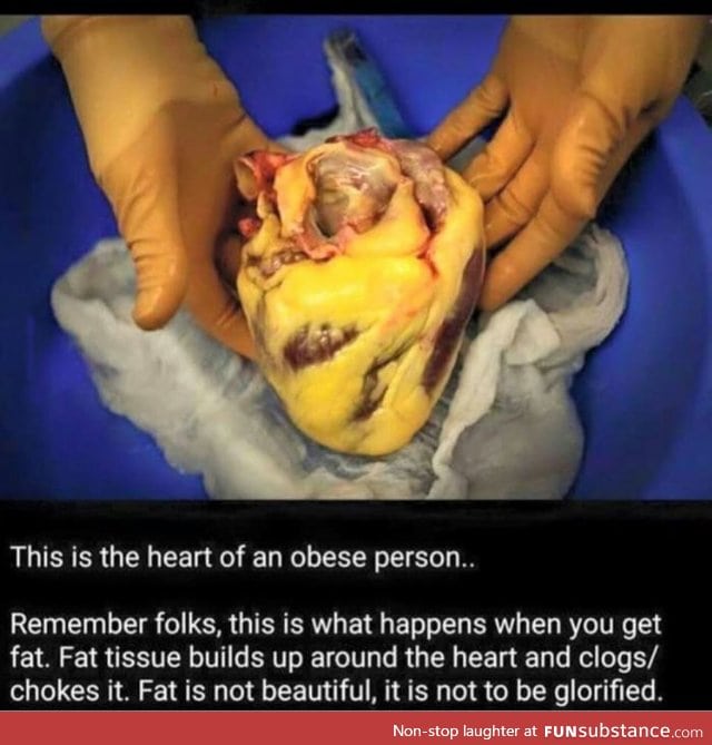 Fat acceptance kills, end of story