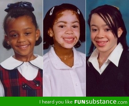 The effects of Vitiligo on a school girl