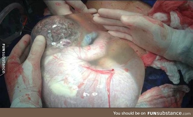 Born with Amniotic Sac intact