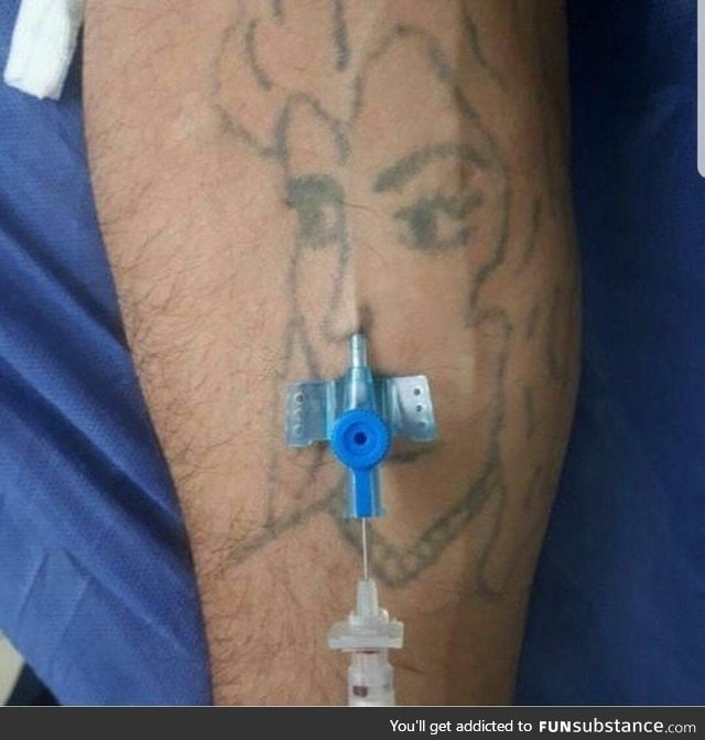 What happens when you give an ENT doctor an IV cannula