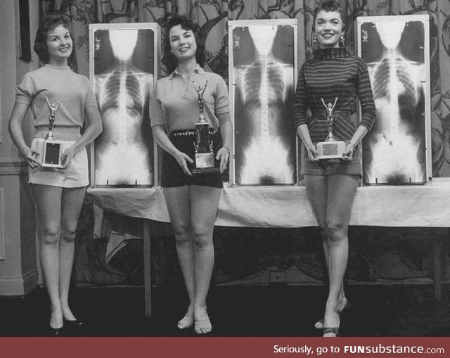 1st, 2nd and 3rd Place in the Miss Correct Posture Contest pose with their X-Rays