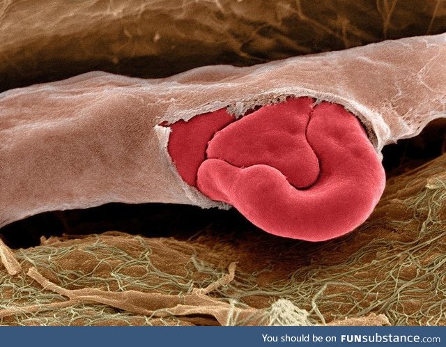 A ruptured capillary with red blood cells, seen at the electron microscope