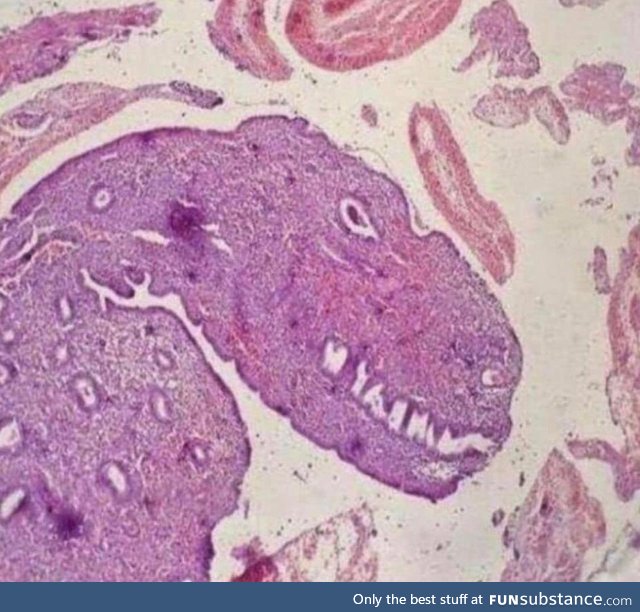 I don't know the results of this biopsy yet, but it seems it's something very aggressive