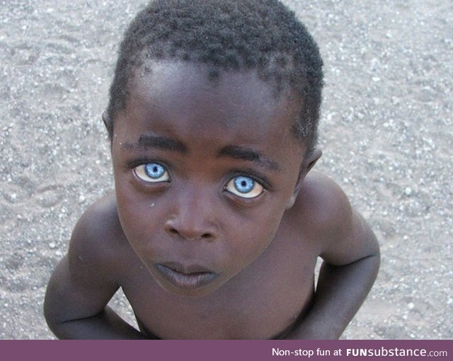 Boy with ocular albinism