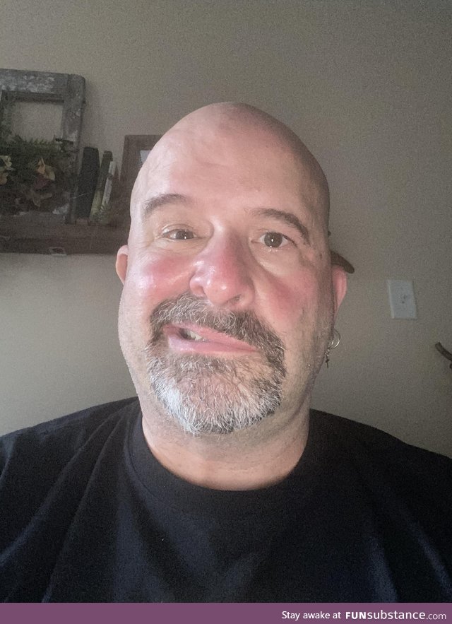 Recently diagnosed with Bell’s Palsy...Which kinda sucks...But on the bright side, as a