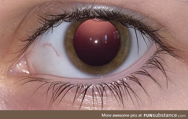 Flash photo of my dilated eye