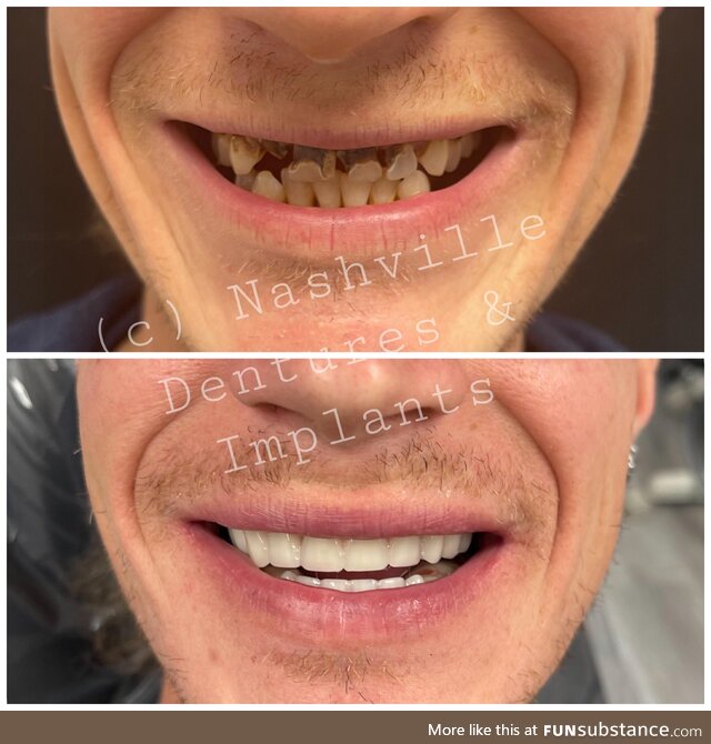 (oc) Fixed implant dentistry is life changing