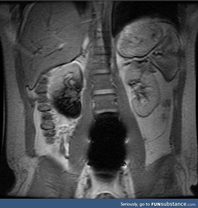The artificial disks in my spine look like a black hole in this MRI [OC]