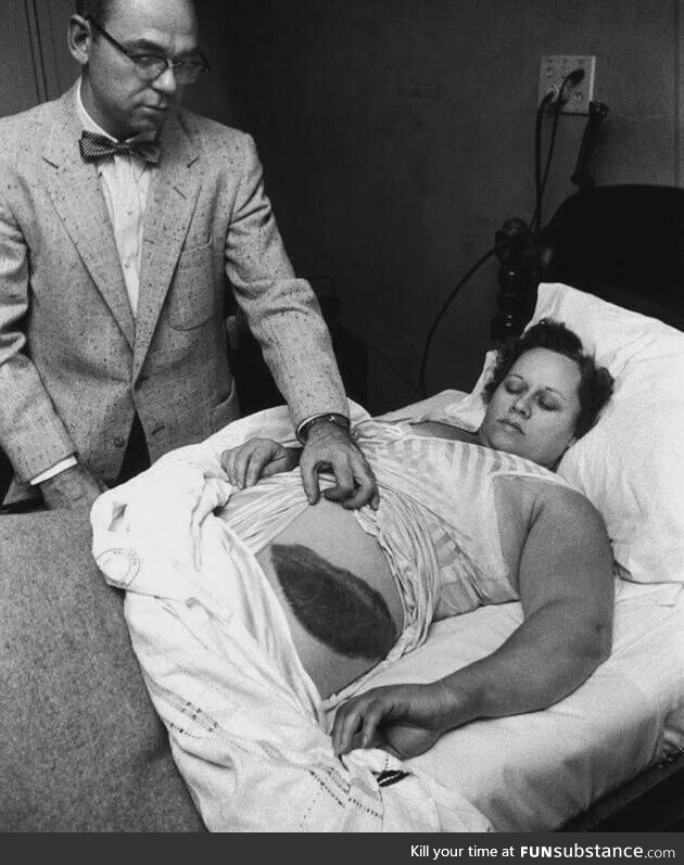 Ann Hodges, the only human being in recorded history to be hit by a meteorite. And