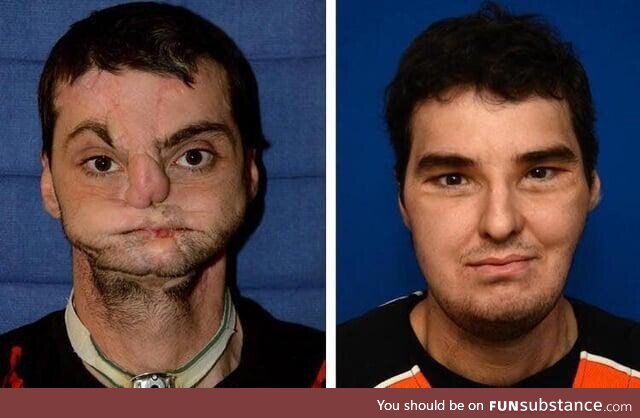 Richard Norris before and after receivingthe world’s first full face transplant