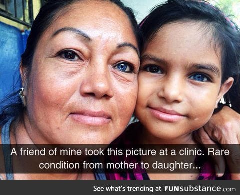 Mother and daughter with heterochromia