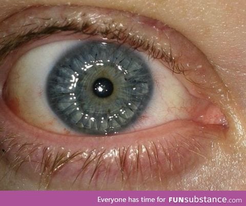 A corneal implant with visible stitches