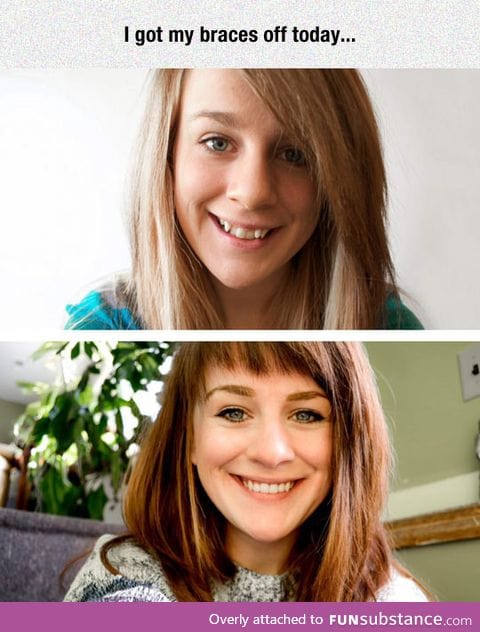 The difference braces can make
