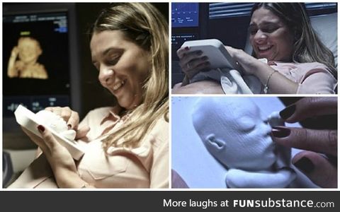 3D printed ultrasound for blind expectant mother