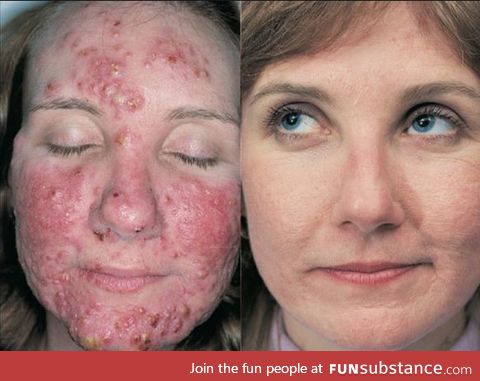 What 4 months of Isotretinoin medication for acne can do