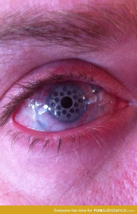A healed after corneal transplant surgery
