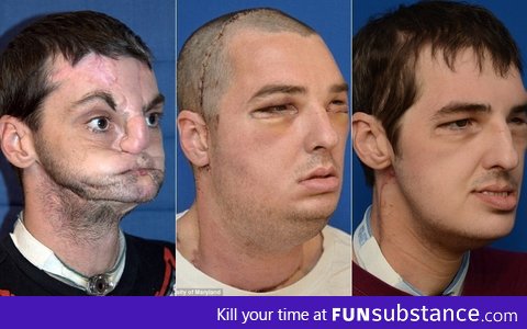 Most Extensive Face Transplant In History