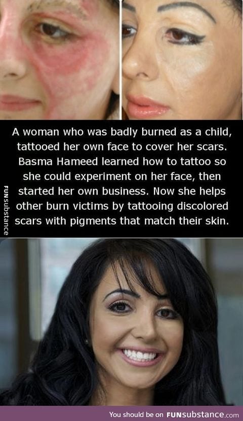 Tattooing  burn victims