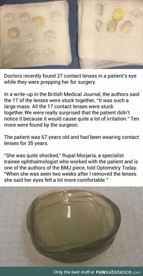 Doctors found 27 contact lenses in a woman's eye, who was scheduled for a surgery