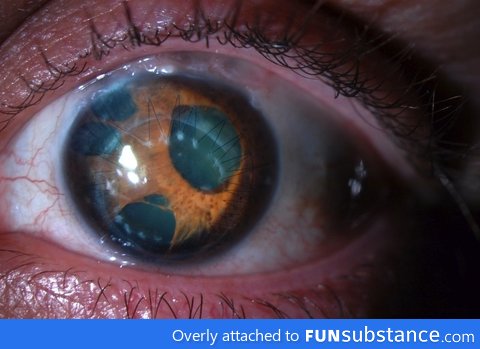 Eye infected with polycoria - Multiple pupils