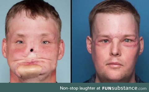 Tearful meeting between woman and man who received face transplant from her dead husband