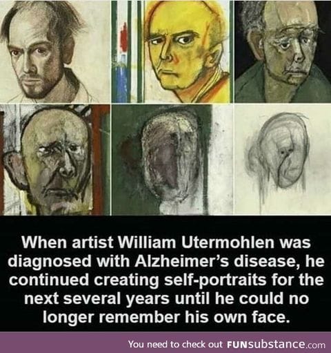Alzheimer's disease