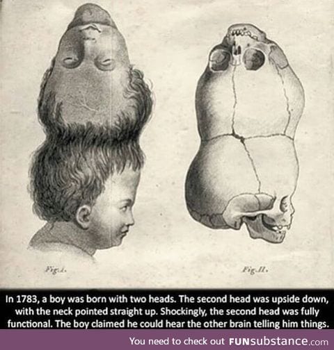 The boy with 2 functional heads