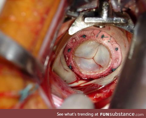 The tricuspid valve of the heart