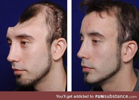 Amazing before and after of a skull reconstruction