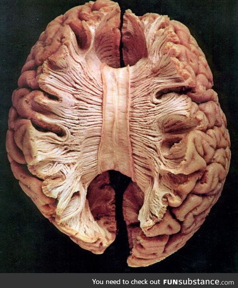 Corpus callosum- the large band of neural fibers connecting the two brain hemispheres