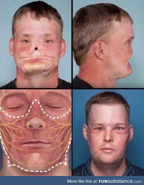 Incredible well performed face transplant