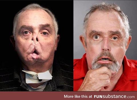 Amazing Face Transplant of Man 7 Years After Tragic Accident