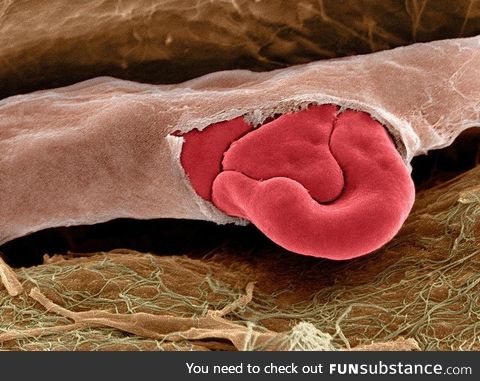 A ruptured capillary with red blood cells, seen at the electron microscope