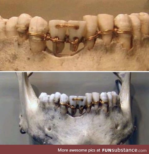4000 year old dental work on a mummy. The two centre teeth are donor teeth