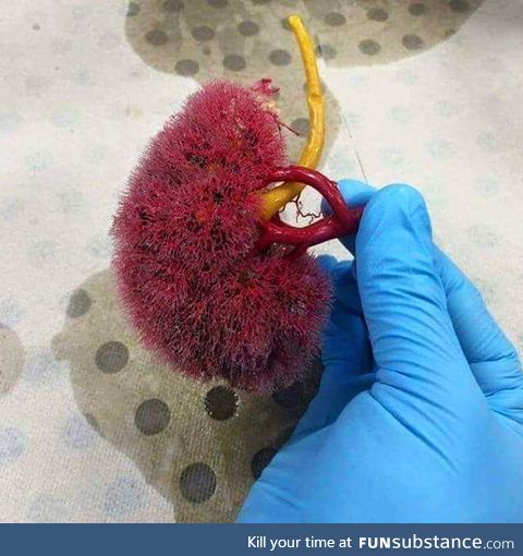 Here's how the kidney looks with its parenchyma removed!