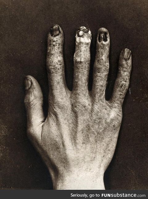 A hand of a radiologist in 1900