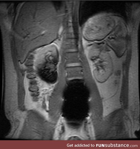 The artificial disks in my spine look like a black hole in this MRI [OC]