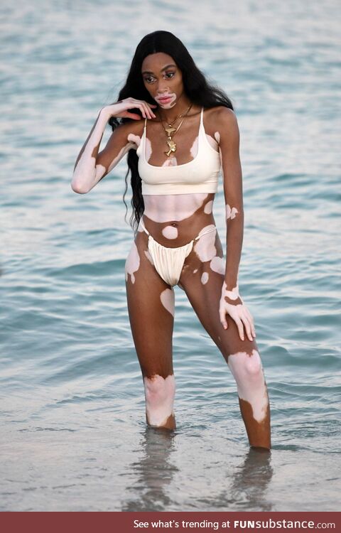 Supermodel Winnie Harlow. Winnie has a skin condition called vitiligo